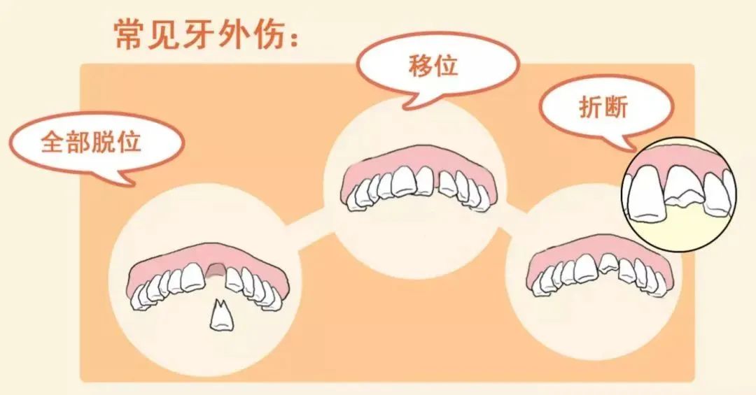 注意！牙齿意外磕掉了，这样做还能接上