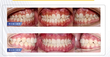 尔睦口腔牙齿矫正案例图